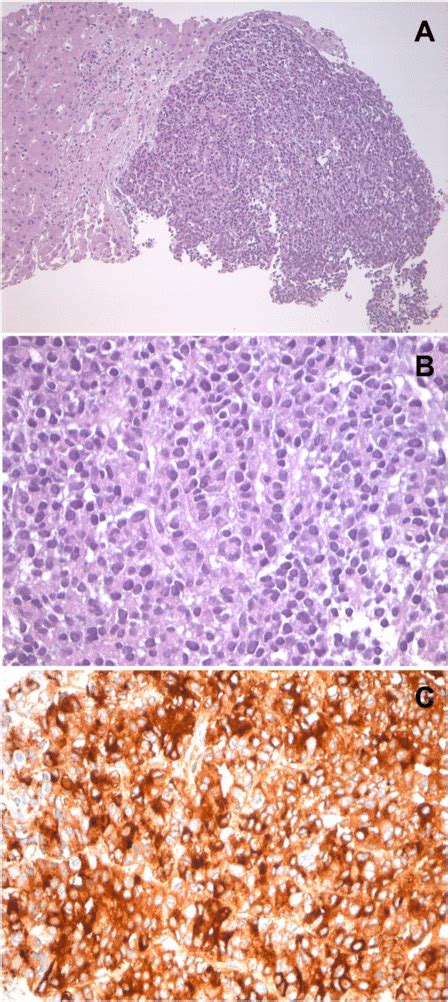 Histomorphology And Immunohistochemistry Of The Liver Tumor From Core