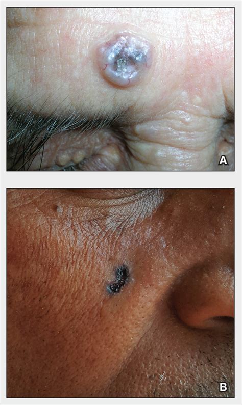 Skin Cancer Types Basal Cell Carcinoma