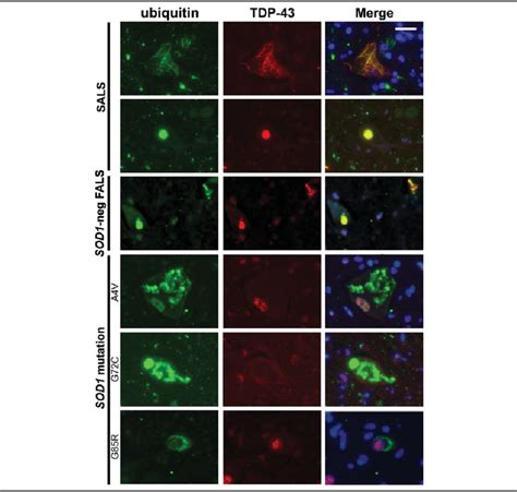 Double Label Immunofluorescence Of Neuronal Cytoplasmic Inclusions Download Scientific Diagram