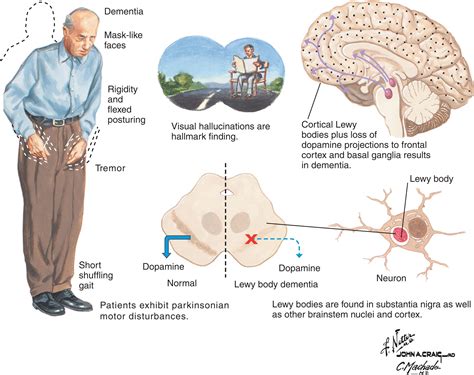 Dementia With Lewy Bodies Clinical Tree