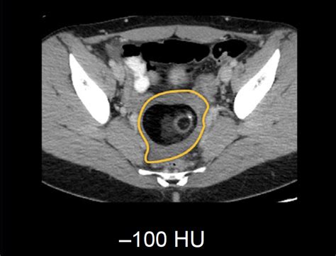 Abdominal Ct Attenuation Litfl Radiology Library