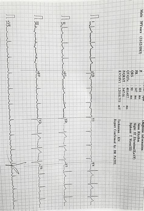 Whats Up With My Ekgs Rdiagnoseme