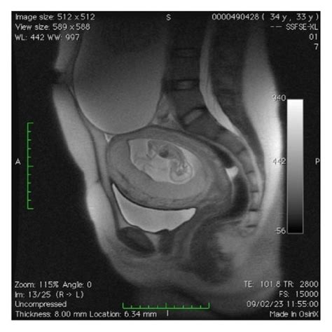 Mri Demonstrating The Relation Between The Adnexal Mass And The