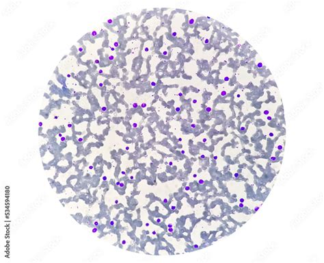 Chronic Myelogenous Leukemia Cml Also Known As Chronic Myeloid