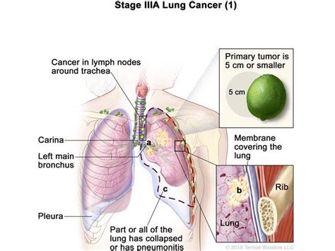 Adjuvant Immunotherapy Approved for Lung Cancer - NCI