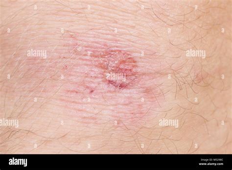 Scraped knee hi-res stock photography and images - Alamy