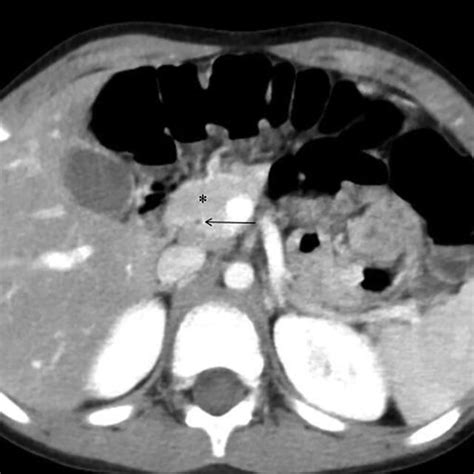 Axial Contrast Enhanced Computerized Tomography Ct Scan Of The