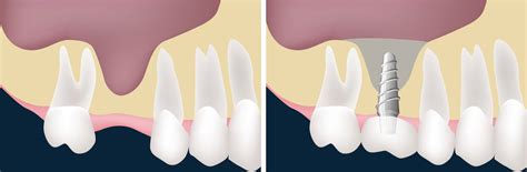 Everything You Should Know About Sinus Lift A Comprehensive Guide