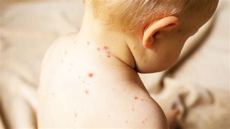 Mumbai Measles Outbreak: Symptoms, Treatment, & More | OnlyMyHealth