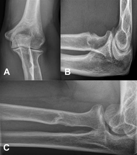 Radiographs Of The Left Elbow In A Anteroposterior B Lateral And