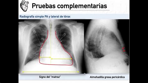 Raio X Derrame Pericardico RETOEDU