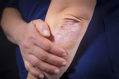 mild psoriasis on elbow - Psoriasis Cure Now