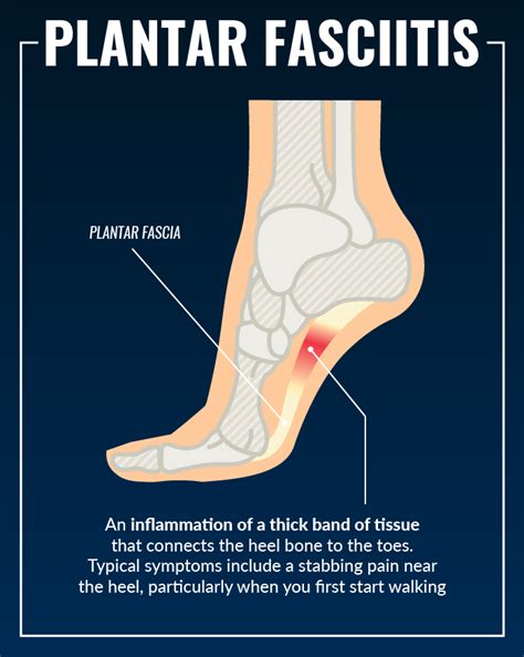 Does Plantar Fasciitis Cause Knee Pain? - Runner's Goal