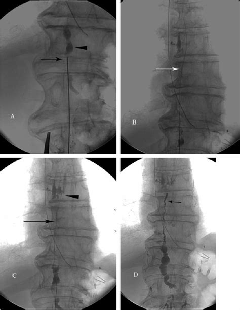 Technical Steps Of Thoracic Duct Td Embolization A Fluoroscopic