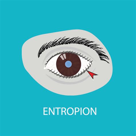 What is Entropion? - Facty Health