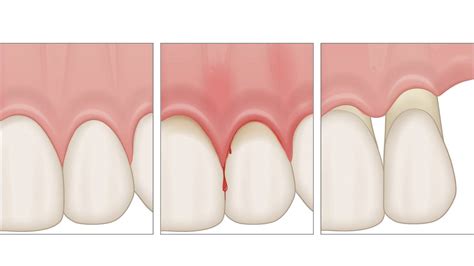 Periodontal Causes Consequences Diagnosis Therapy And