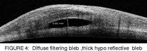 Figure 1 From Analysis Of Bleb Morphology After Trabeculectomy With