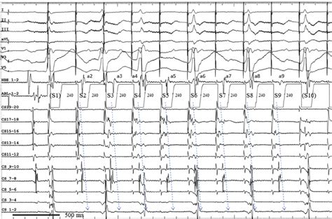 Surface Electrocardiogram And Intracardiac Electrograms During Burst