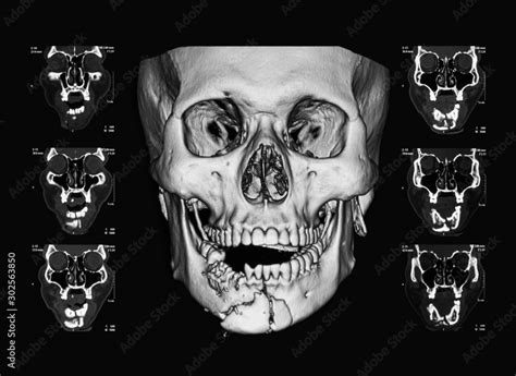 Computed Tomography Ct Scan Of Facial Bone A Case Of Mandibular