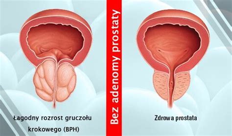 Prostata Leczenie Przerost Gruczo U Krokowego Wra Enie