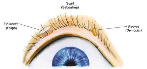 Blepharitis American Academy Of Ophthalmology