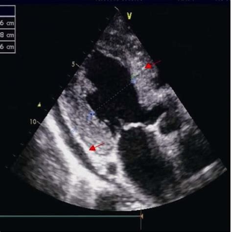 Echocardiography Of The Cardiac Amyloidosis Patient A Download