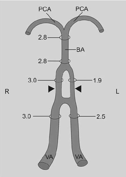 Schematic Arrangements Of The Vessels Of Vertebrobasilar System And