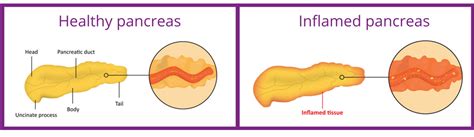 Is Pancreatitis A Pancreatic Cancer Risk Factor Pancreatic Cancer Signs