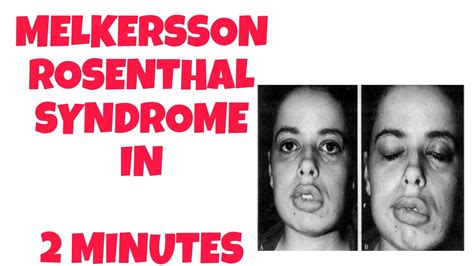 Melkersson Rosenthal Syndrome 2 Minutes Knowledge Syndrome Of