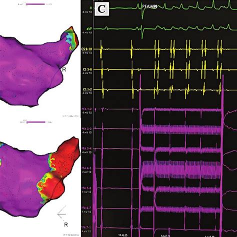 Isolation Of Pulmonary Veins With Pfa Electroanatomical Voltage Maps