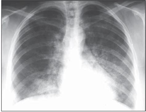 Chest Radiography Posteroanterior View Showing Opacities In The Air