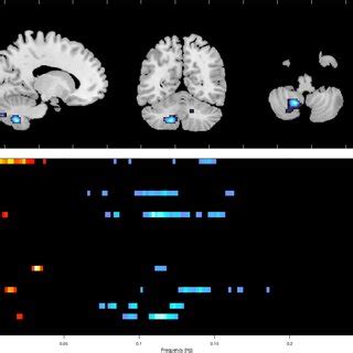 Catatonia Is Associated With Altered Connectivity Of Multiple Brain