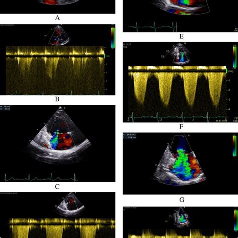 Typical Echocardiography Of Color And Continuous Wave Doppler In