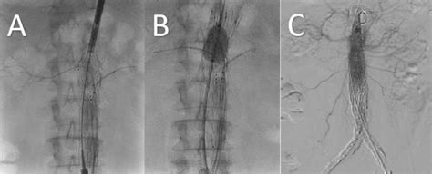 Fenestrated Endovascular Aortic Repair Intraoperative Images Download Scientific Diagram