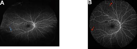 Figure 3 From Comparison Of Ultra Widefield Fluorescein Angiography