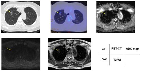 Lung Cancer Mri