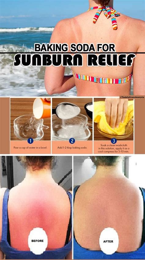 How To Get Relief From Sunburn In Just 10 Mins