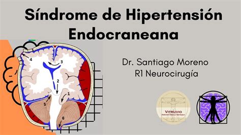 S Ndrome Hipertensi N Endocraneana Dr Santiago Moreno Garc A Youtube