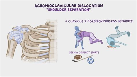 Anatomy Clinical Correlates Clavicle And Shoulder Osmosis