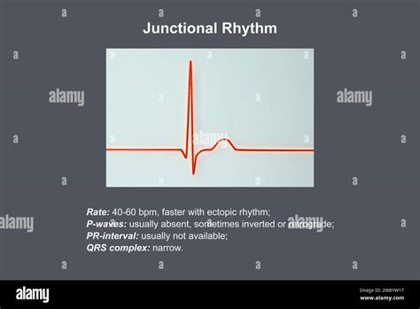 Junctional Rhythm Of The Heartbeat Illustration Stock Photo Alamy