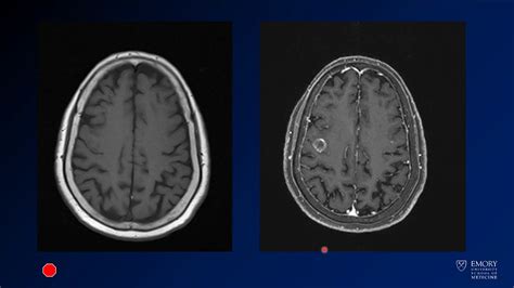 Imaging Intracranial Hemorrhage Case 2 Metastases YouTube