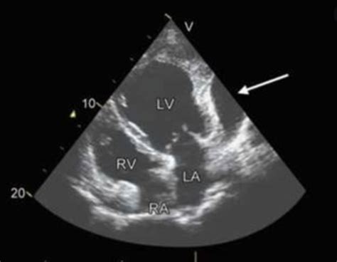 Echocardiography 2 Final Flashcards Quizlet