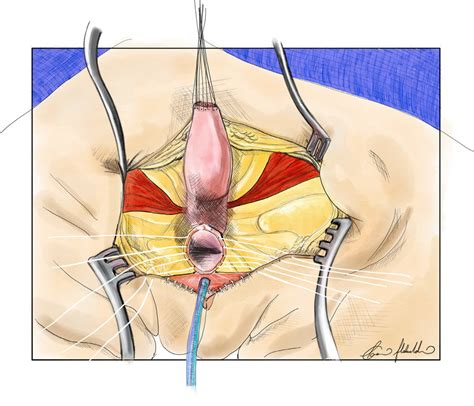 4 Urethroplasty Performed With Mapping Of The Anal Sphincter And