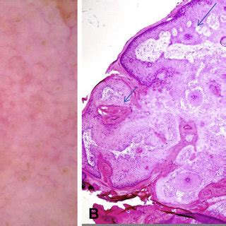 A Scanning Magnification Papillated Epidermal Hyperplasia