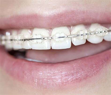 ceramic braces - Amazing Smiles