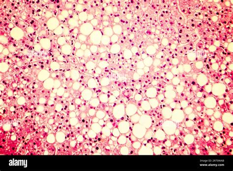 Hígado graso esteatosis hepática Fotomicrografía que muestra grandes