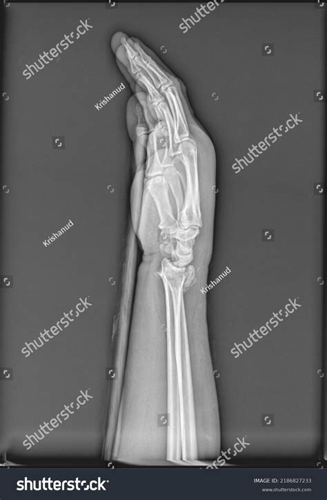 Forearm Xray Showing Distal Radius Ulna Foto Stok Shutterstock