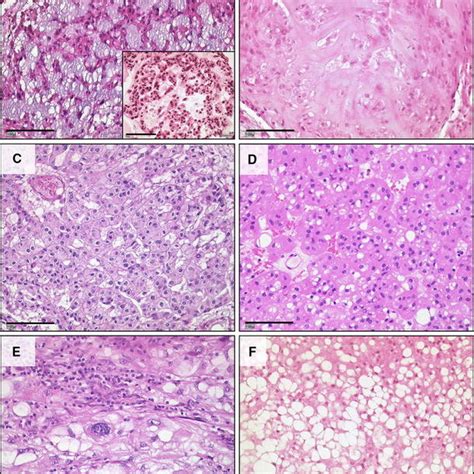 Histomorphology Of Chordomas And A Benign Notochordal Tumor