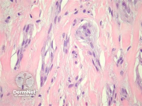 Neurothekeoma Pathology