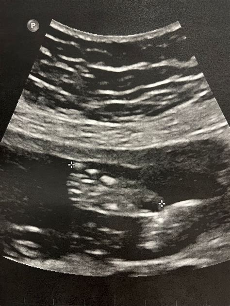 Week Ultrasounds August Babies Forums What To Expect